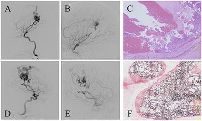 Impact of Pre-operative Embolization With Onyx for Brain Arteriovenous Malformation Surgery